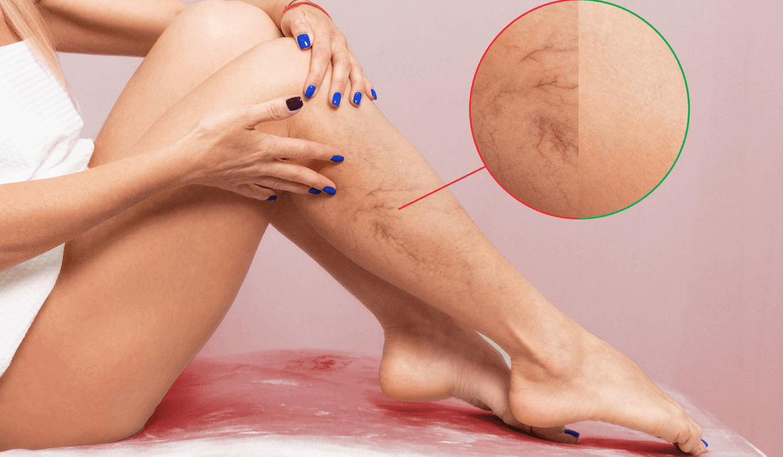 solutions naturelles pour troubles de la circulation sanguine